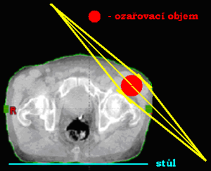 Velmi šikmý vstup centrálního paprsku do ozařovaného objemu