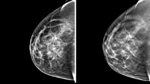 A standard digital mammogram, left, compared to a 3-D tomosynthesis mammogram, right.